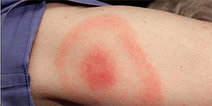 Mold Misdiagnosed: Lyme's Disease