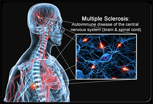 Mold Misdiagnosed: Multiple Sclerosis